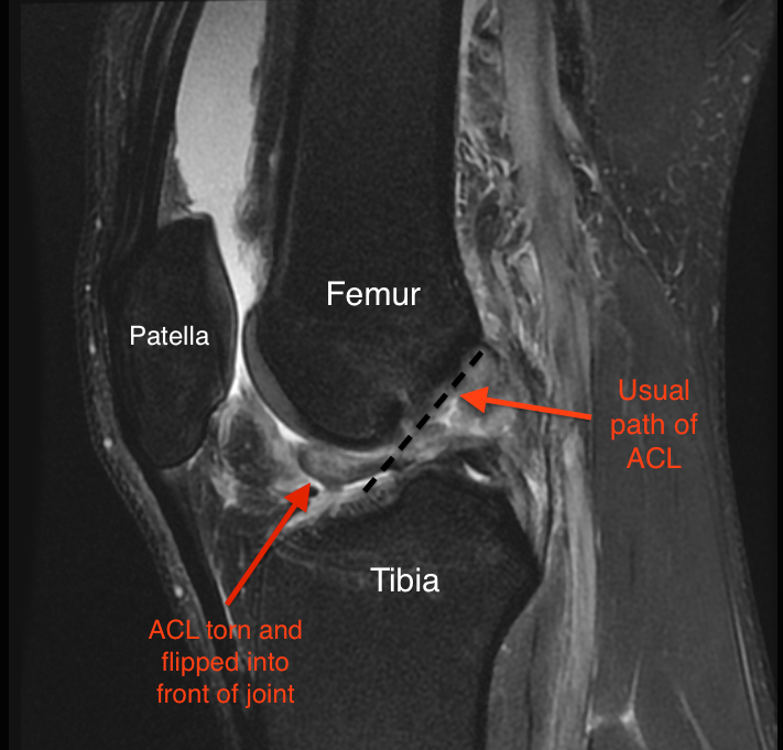 Torn ACL Symptoms And Diagnosis Jeffrey H Berg M D 