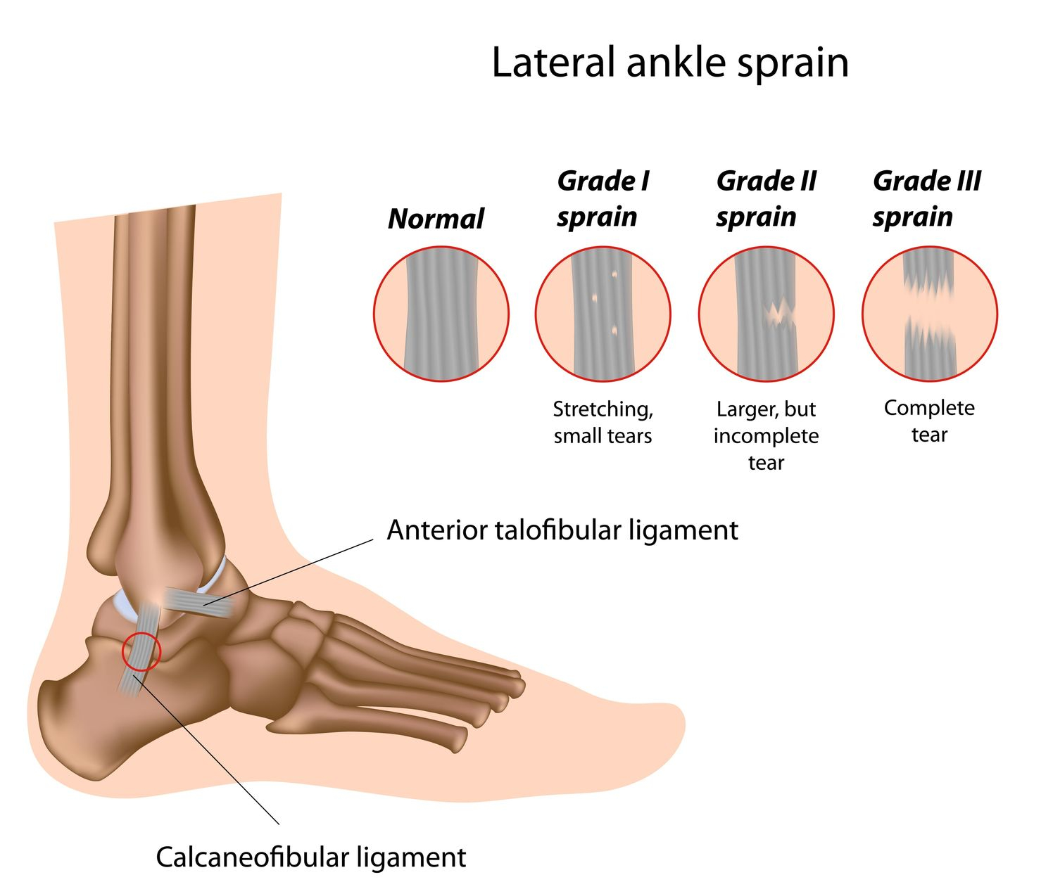 Ankle sprain: MedlinePlus Medical Encyclopedia Image