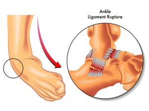 Sprained Ankle Symptoms