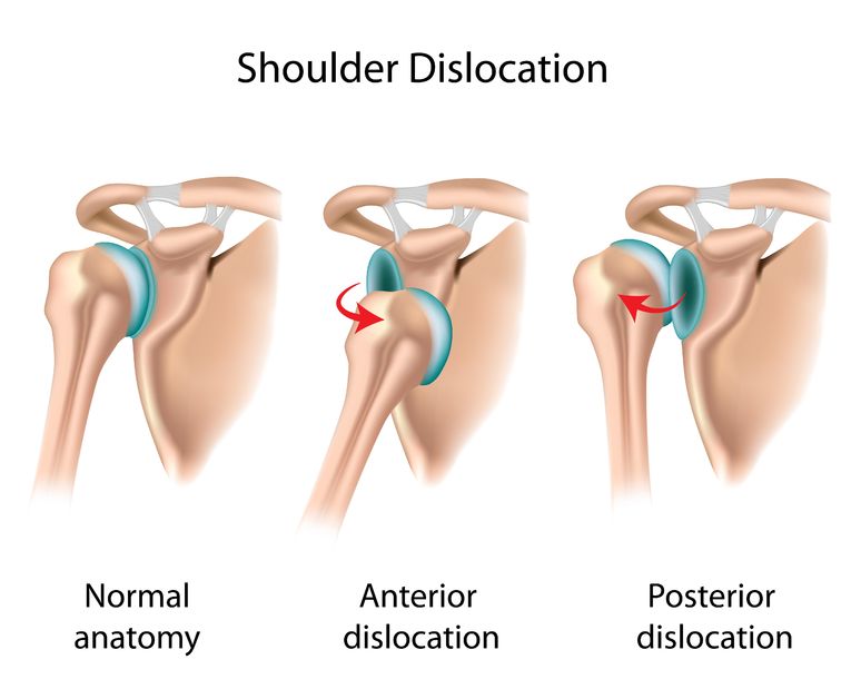 Shoulder Instability Anatomy Causes Video Jeffrey H Berg M D 