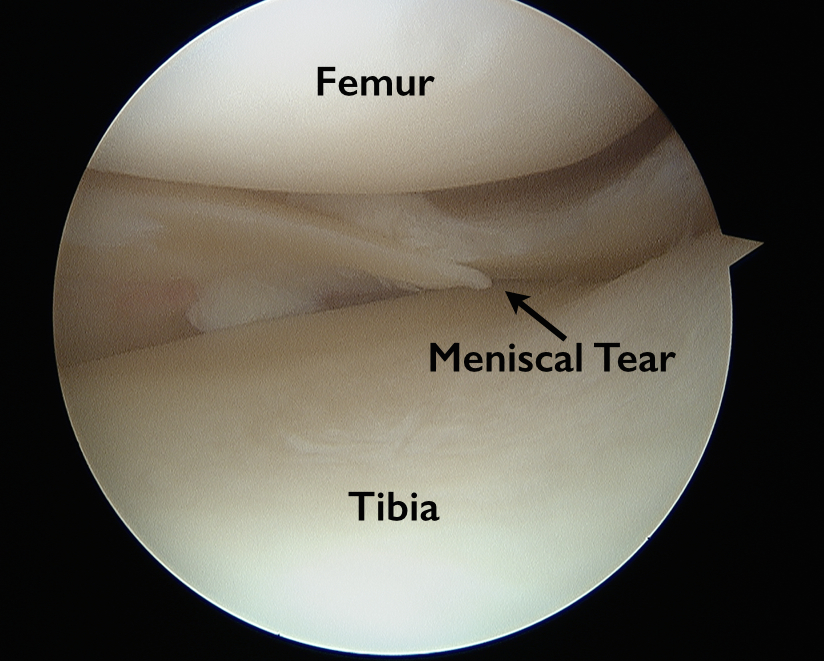 Anatomy Of The Knee Meniscus