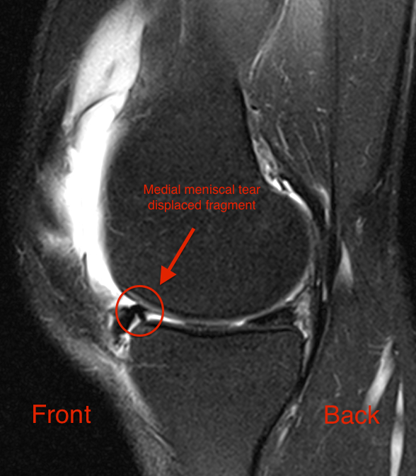 MRI image of a torn meniscus