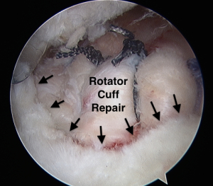 Cuff Repair Surgery  Town Center Orthopaedics