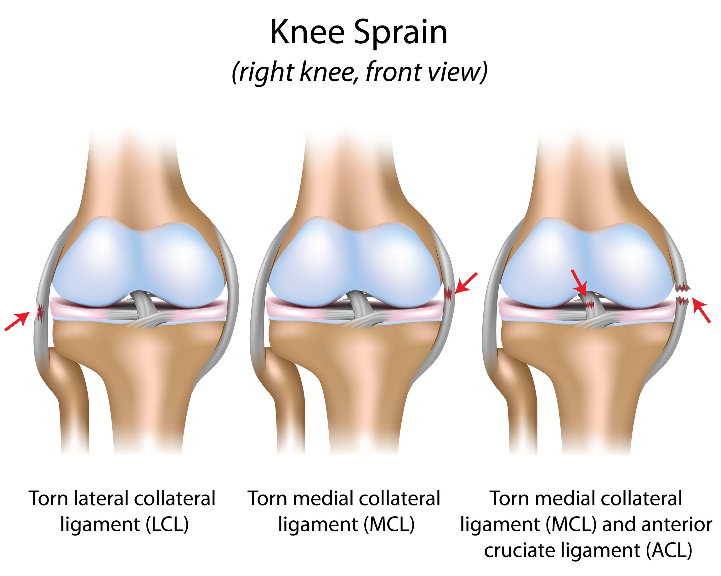 Two Boneheads Video Series: The MCL Sprain - Town Center Orthopaedics