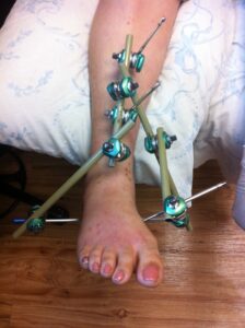 Ankle Fracture Treatment